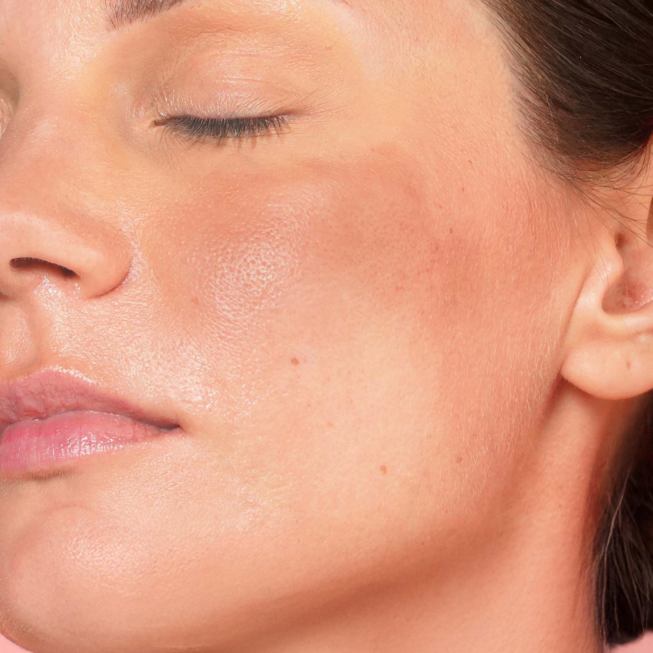 whose skin’s beauty barrier is compromised with blotchy skin 