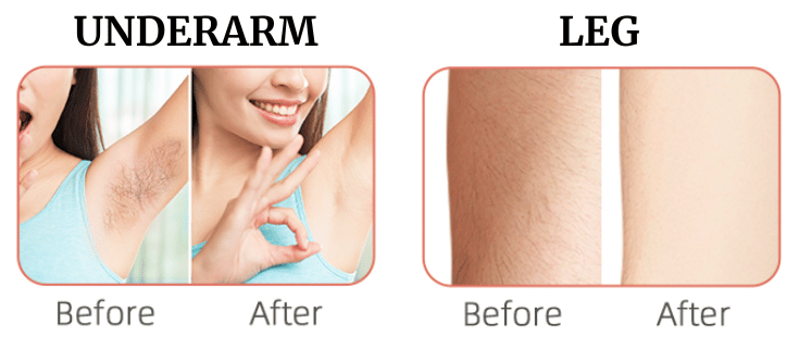 permanent hair removal at home; woman showing her results after IPL hair removal on underarms and legs