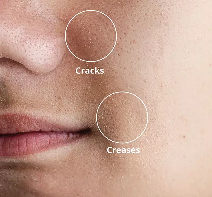 Dehydrated skin with cracks and creases