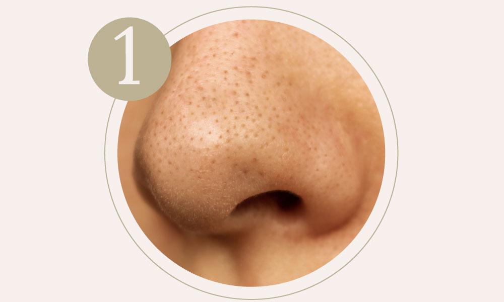 Blackheads on a nose