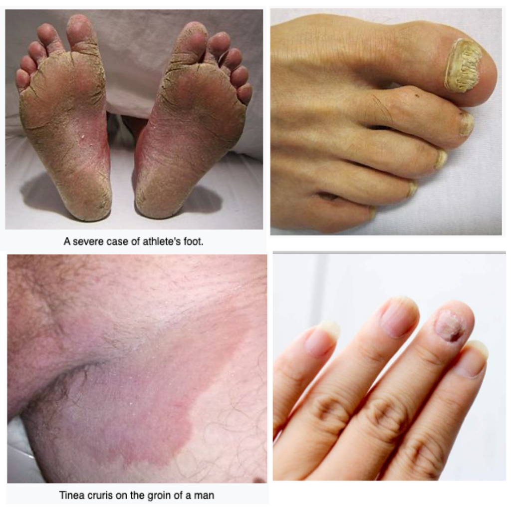 Dr. Cole's Protocol For Skin & Nail Fungus