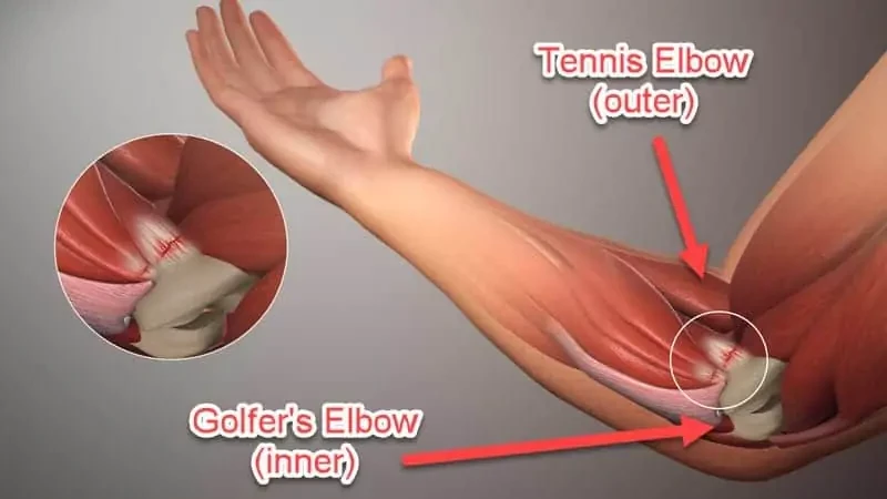 tennis elbow supplement for tendonitis saltwrap