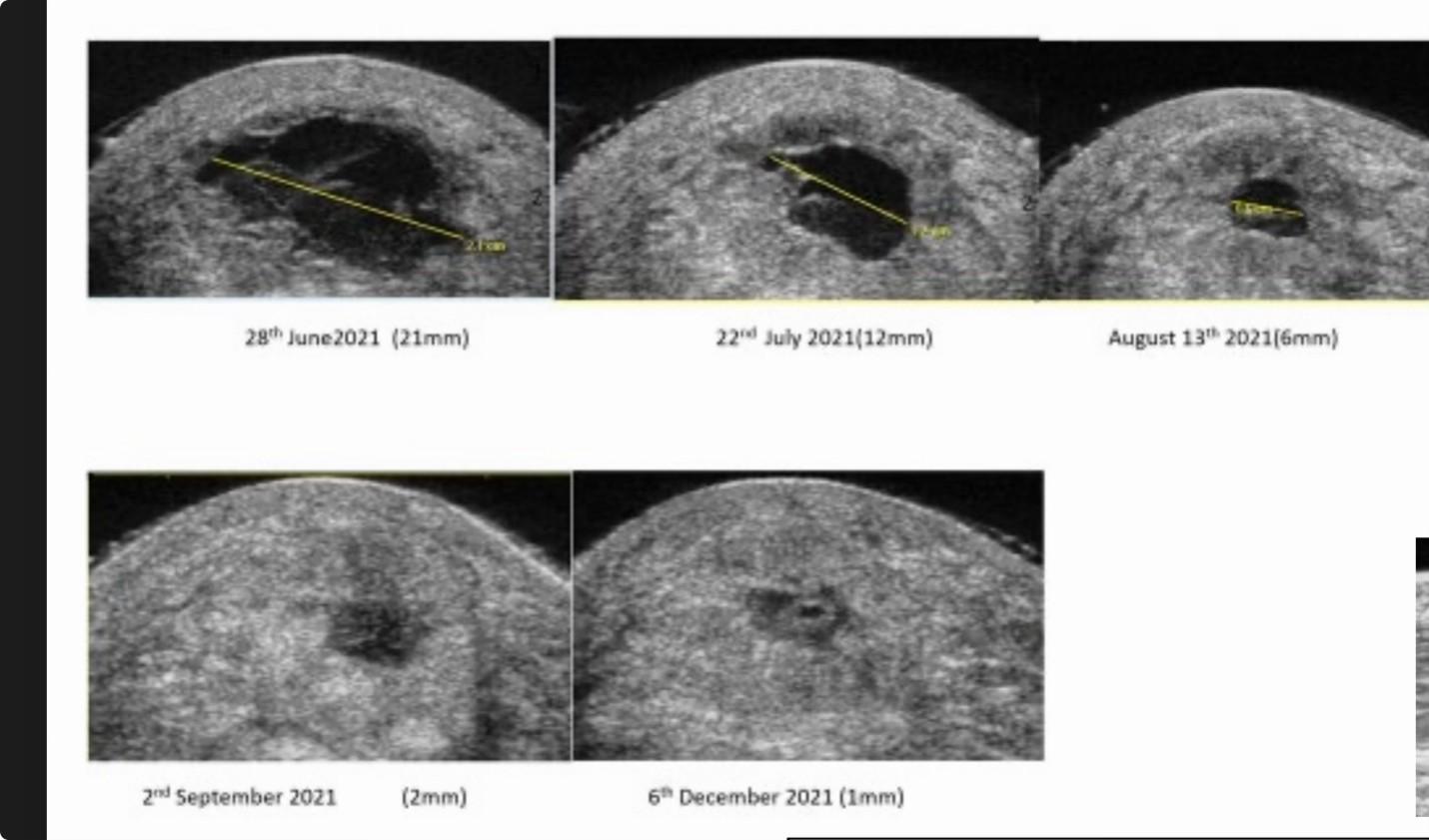 You can see that, as time progresses, the darkened area — the unhealthy “donut hole” — gets smaller. Not only that, but it is replaced by strong, healthy tendon tissue!