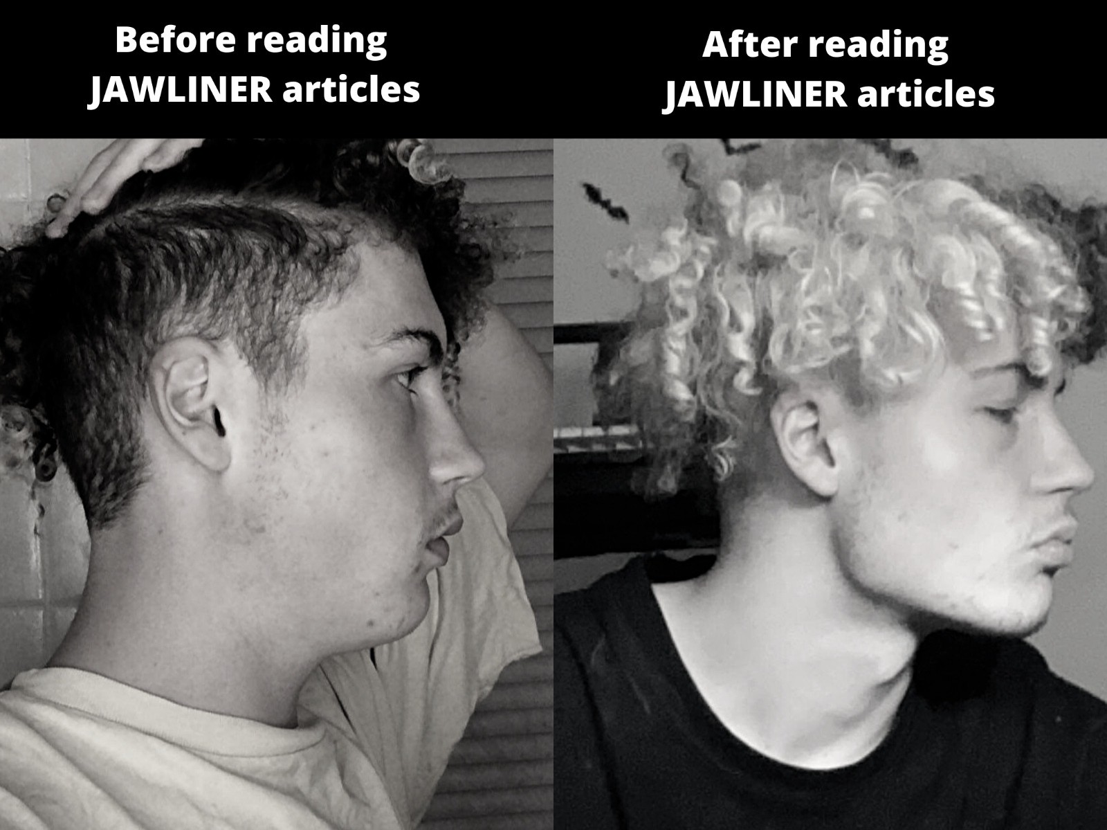 jawliner before and after
