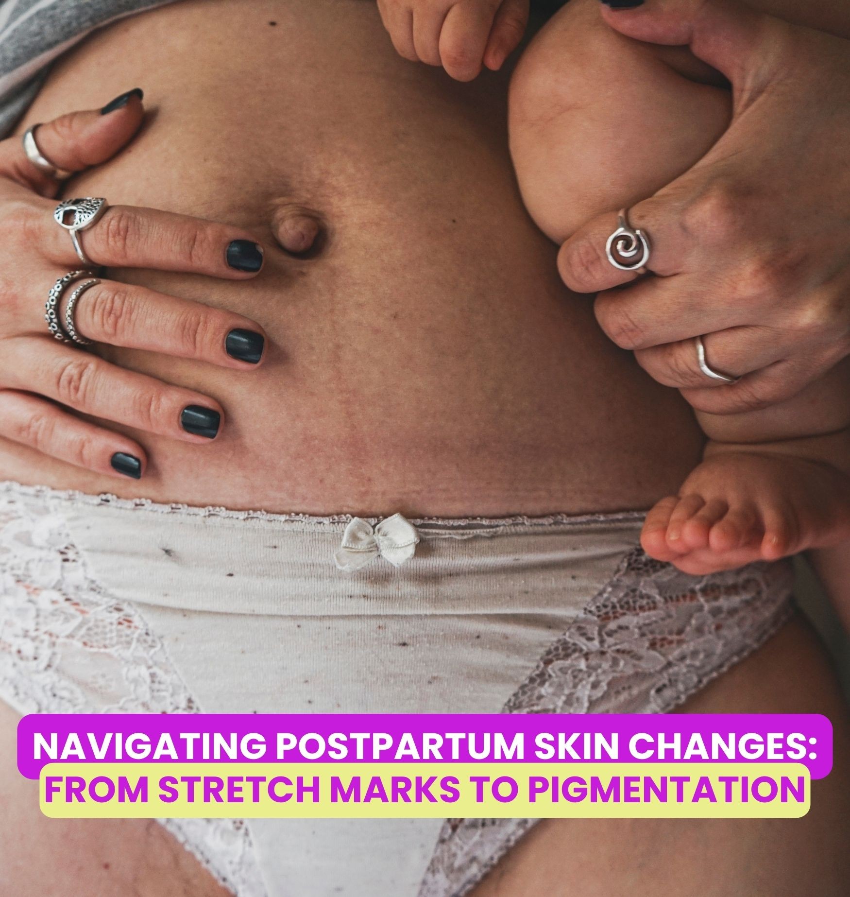 Navigating Postpartum Skin Changes: From Stretch Marks to Pigmentation