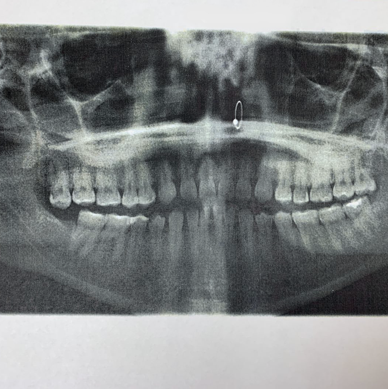 10 Fascinating Pictures of Body Jewelry in XRays BodyCandy