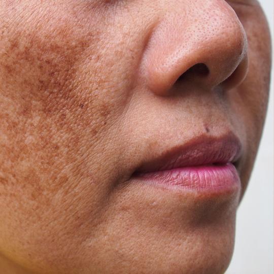 The 3 Main Types of Melasma You Should Avoid.