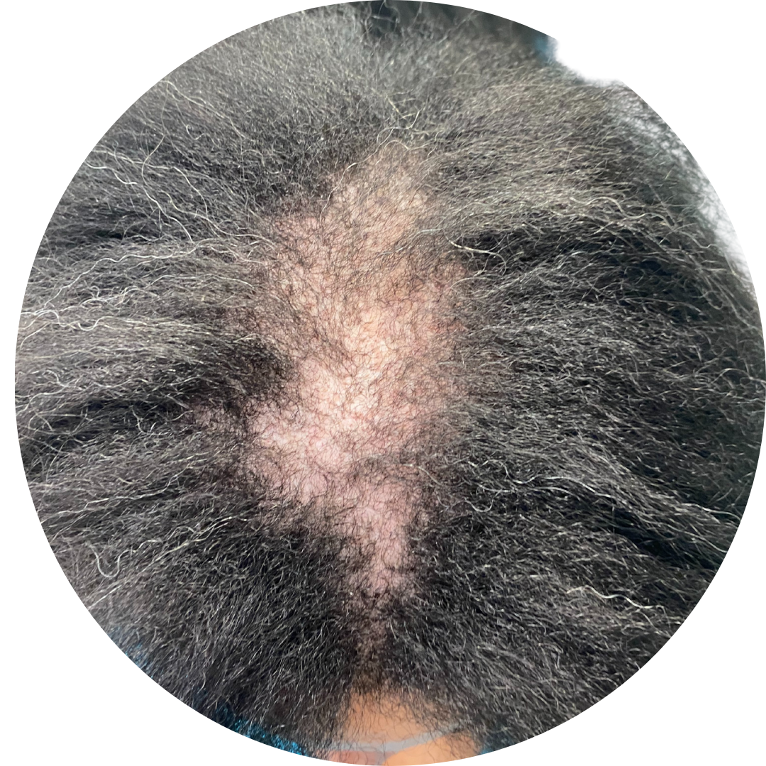 Angela's before, CCCA diagnosis