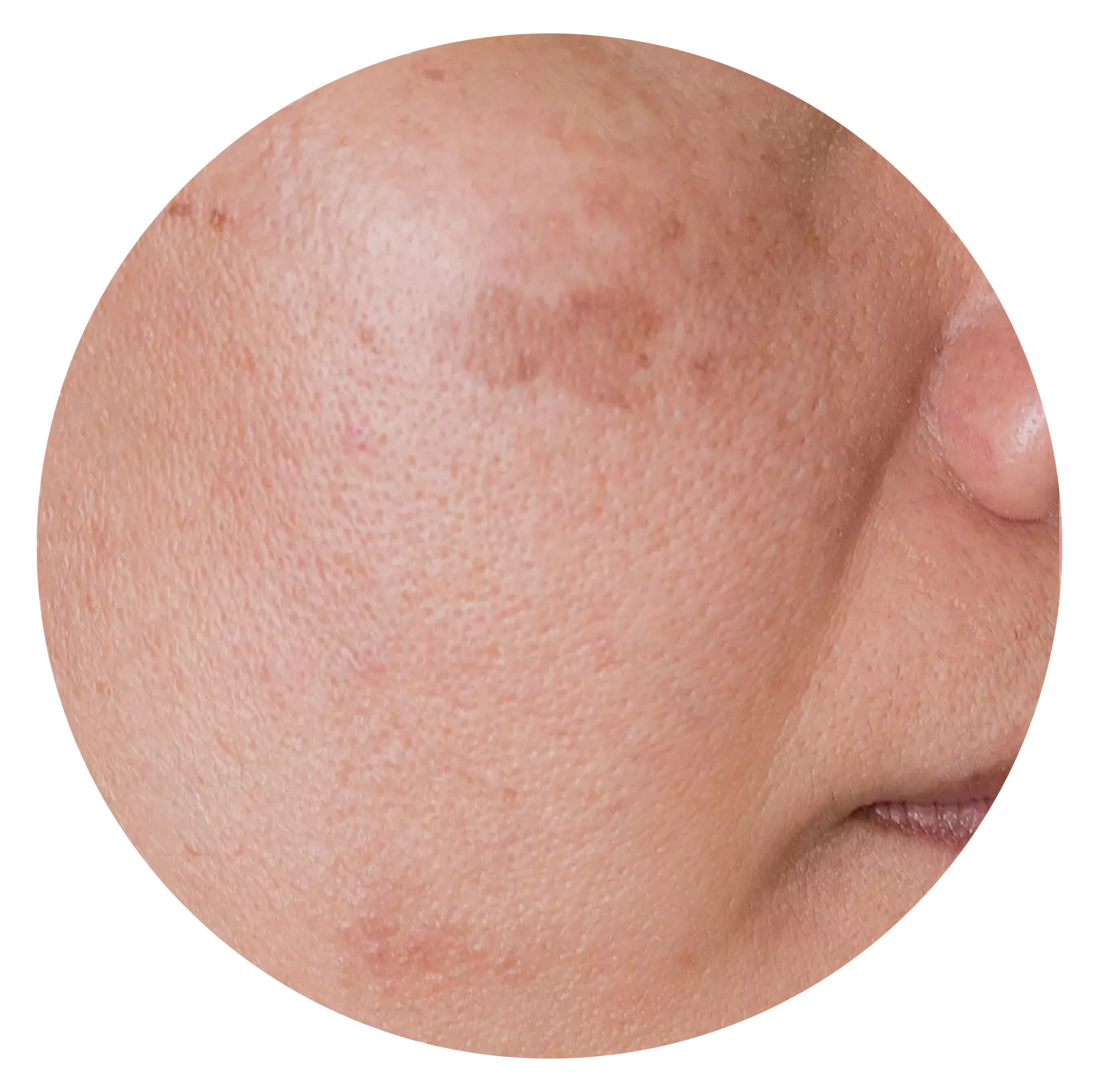 Uneven Skin Tone