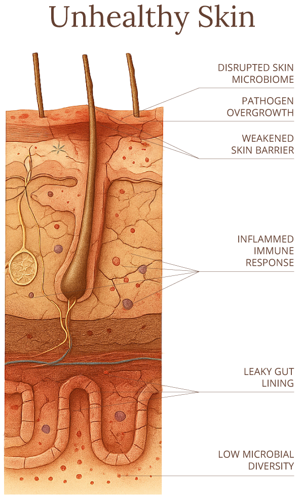 Cross-section showing unhealthy skin and gut. Labels highlight disrupted skin microbiome, pathogen overgrowth, weakened skin barrier, inflamed immune response, leaky gut lining, and low microbial diversity.