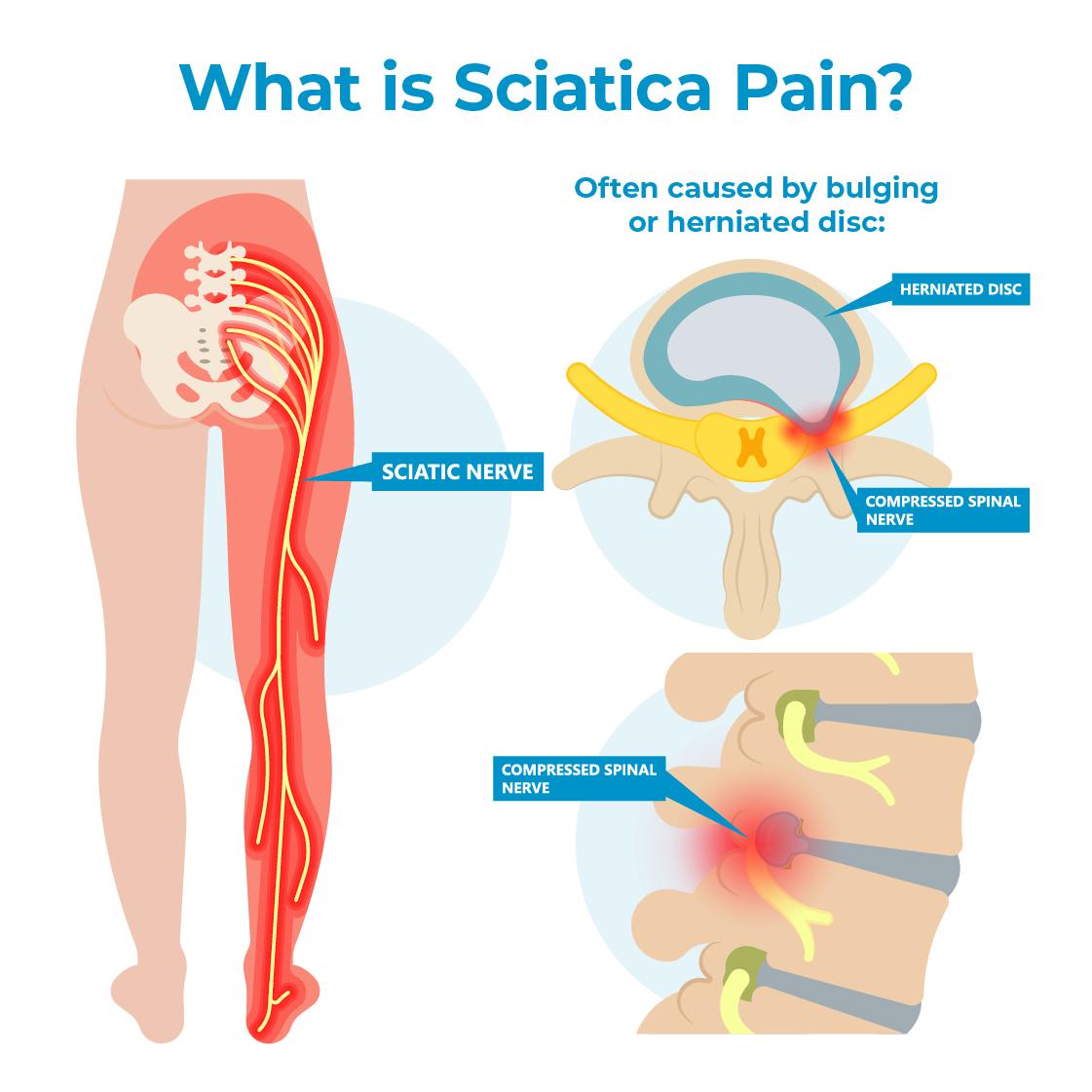 How to Use a TENS Unit for Sciatic Nerve Pain Relief 