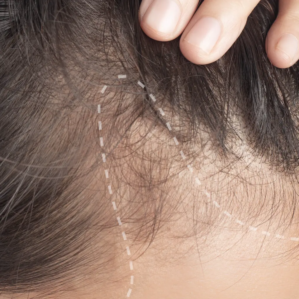 Scalp aging