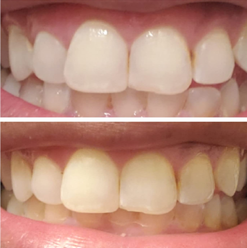 Charcoal's Transformative Teeth Whitening