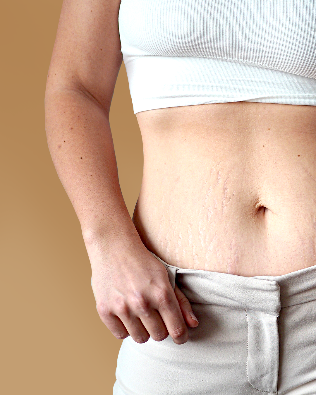 Stretch marks on the tummy