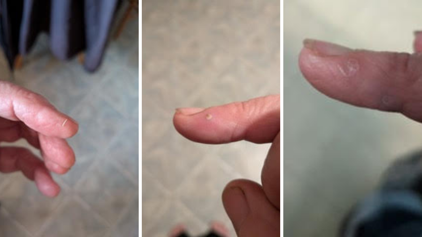 Sliver Removal with Extraction Balm