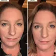Before and After image of a customer using Kesaradi Daily Glow Face Oil