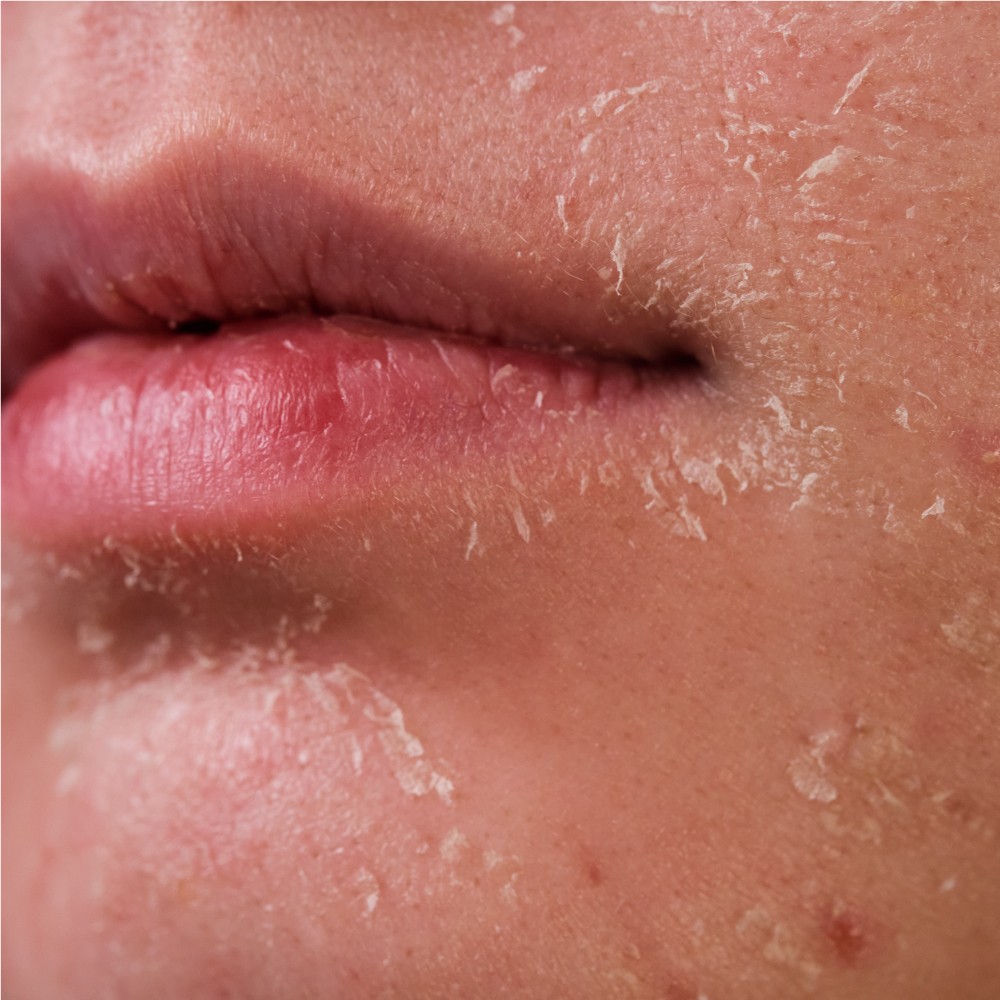 what is dehydrated skin?