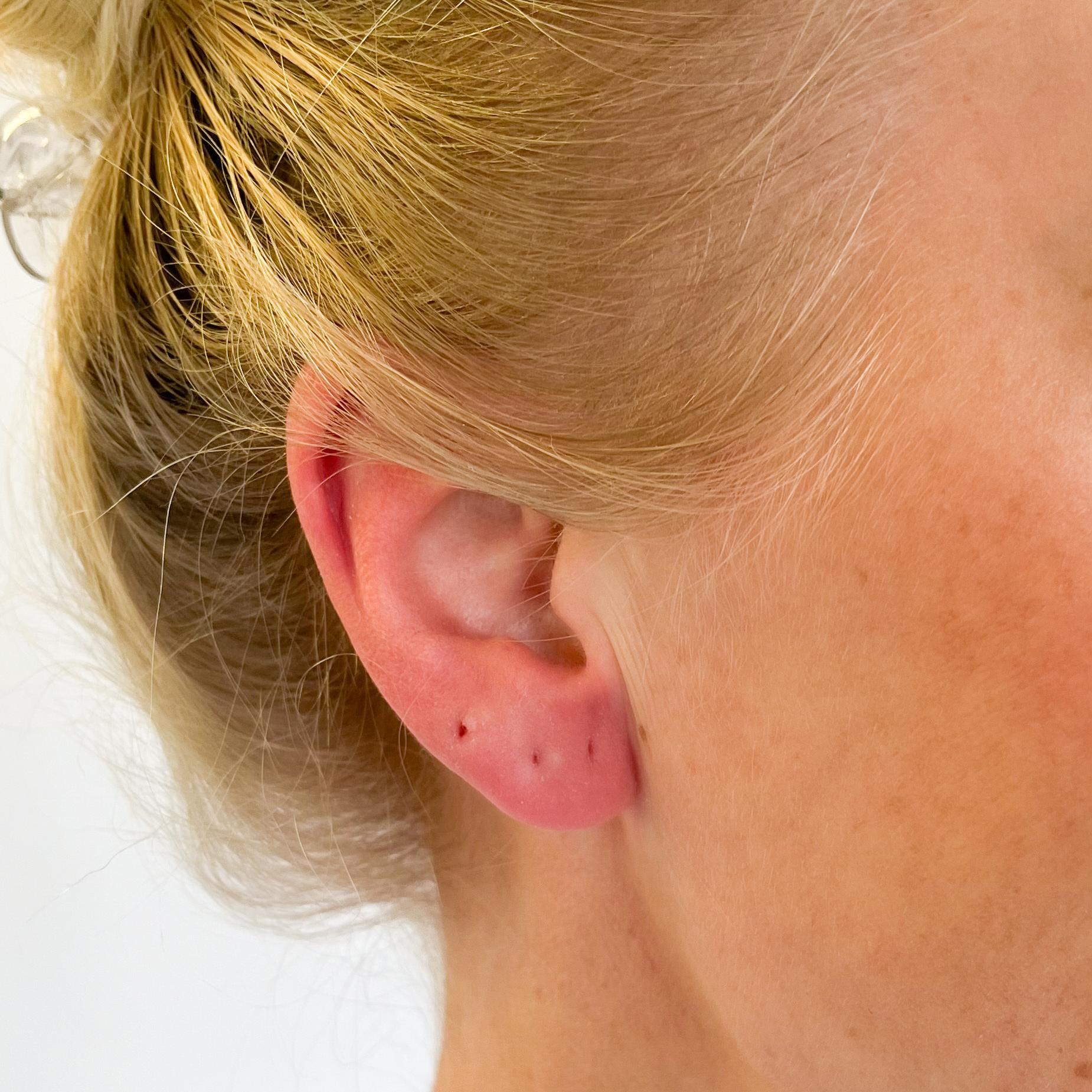 Treatment for infected cartilage on sale piercing