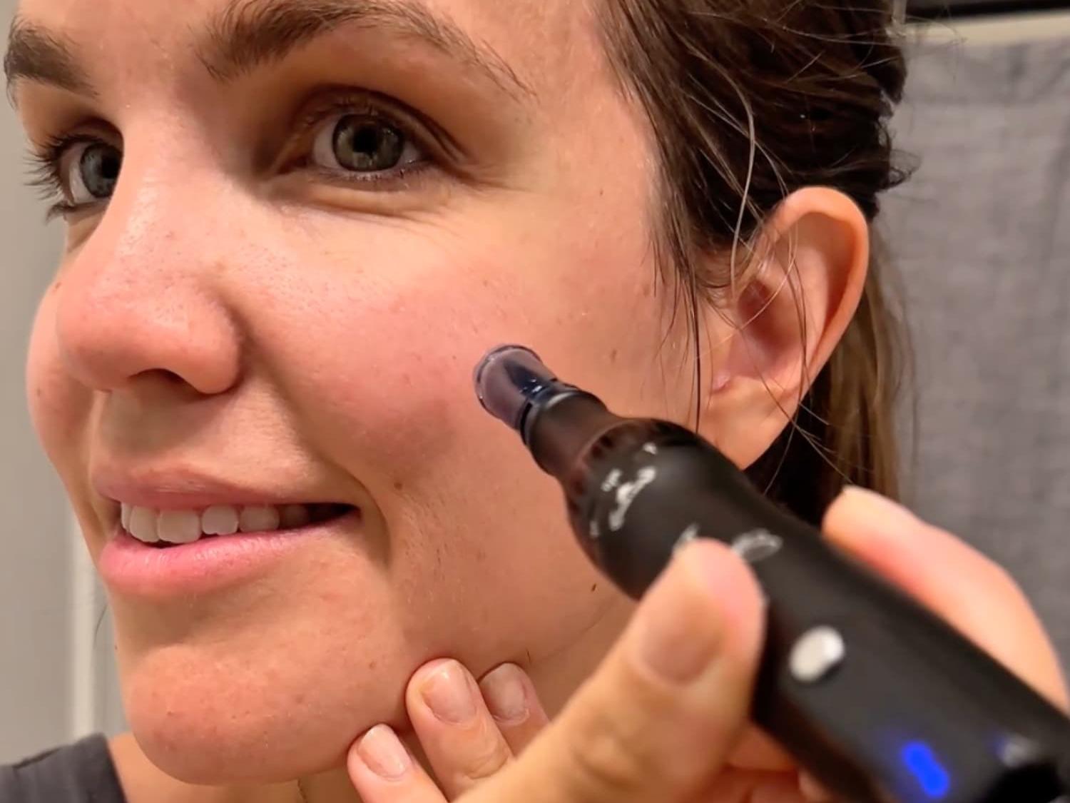 woman microneedling her face using beautimate microneedle pen