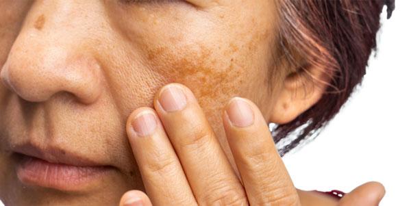 Woman showing hyperpigmentation on face