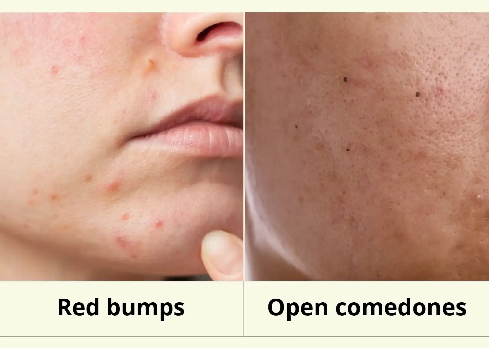 different type of Comedones