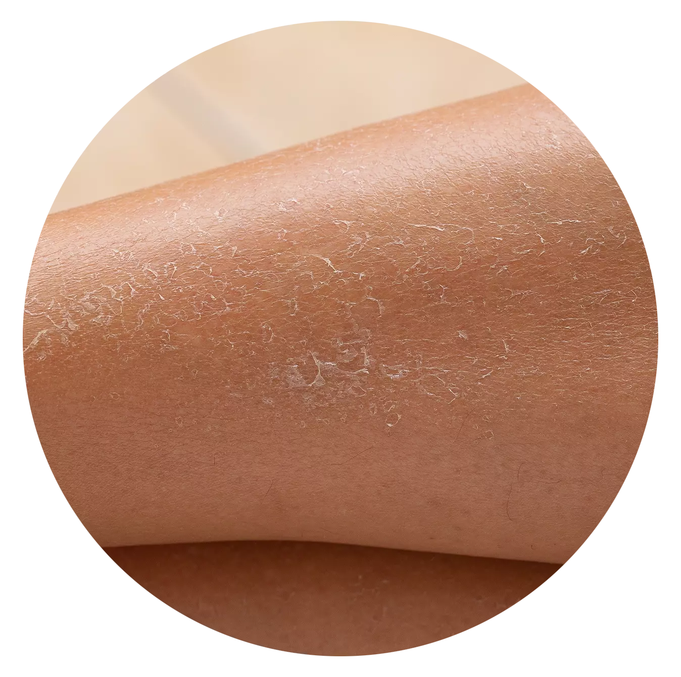 Dryness and Dehydration