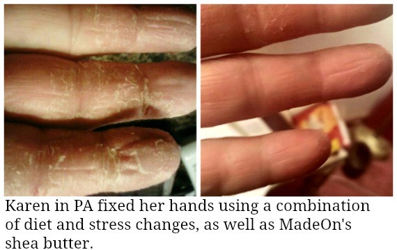 lotion bar before and after on hands with psoriasis