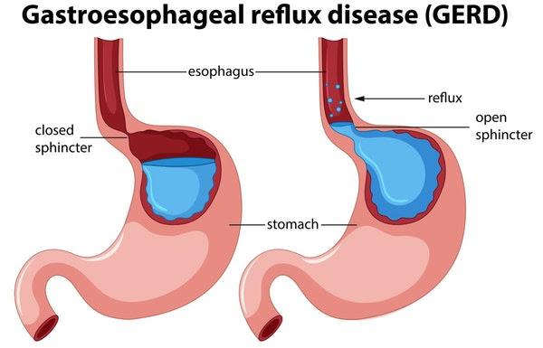 Gastroesophageal Reflux Disease GERD Stomach