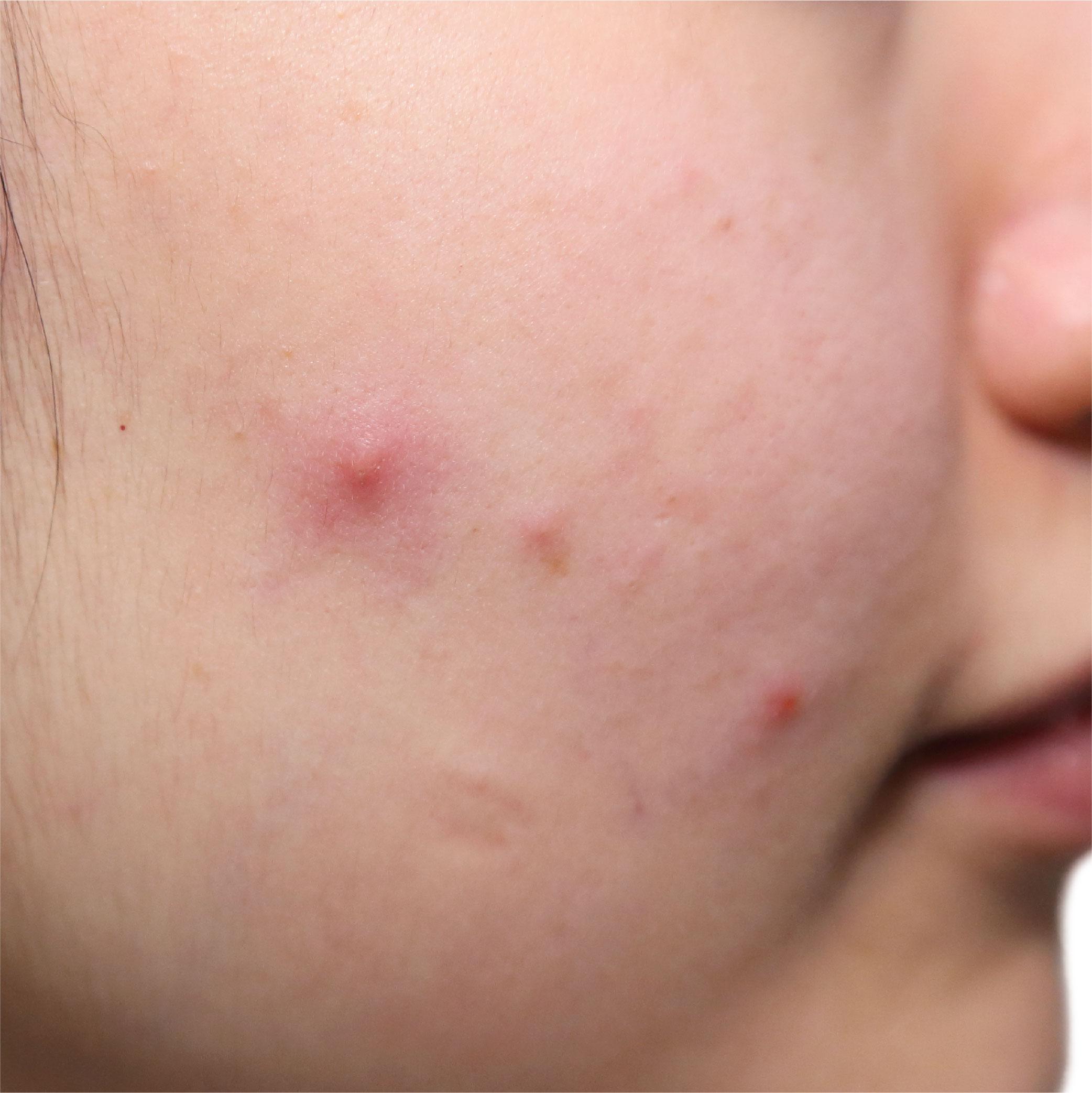 picking & popping acne scars