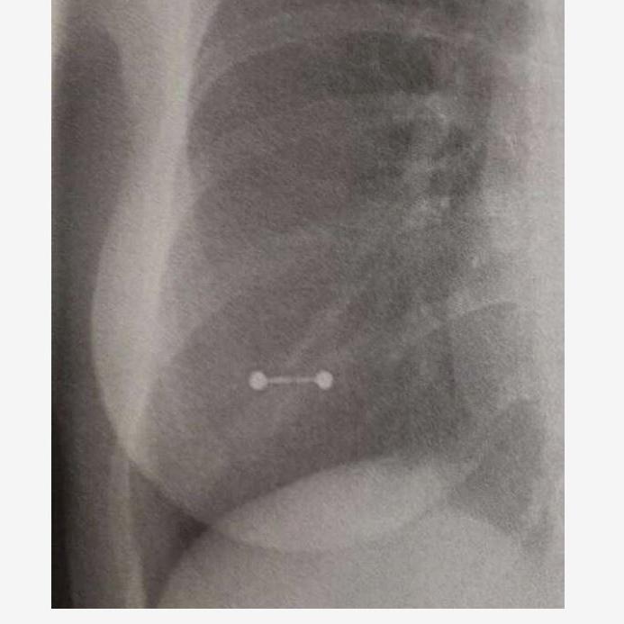 10 Fascinating Pictures of Body Jewelry in XRays BodyCandy