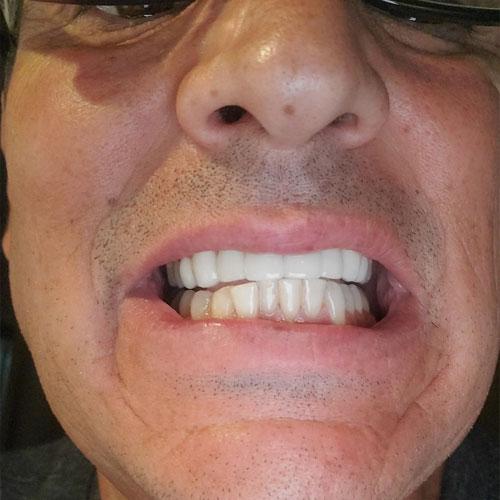 Ivory Oral Plaque Remover