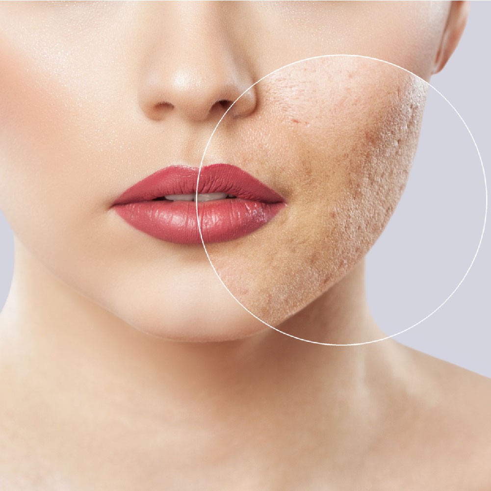explanation of acne scarring and how it is related to your skin