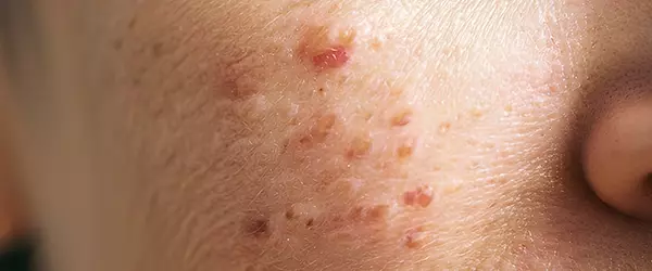 Eruptions on the skin
