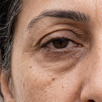 Dull, Dry, Puffy under eyes