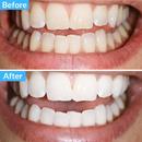 Polar MD teeth whitening