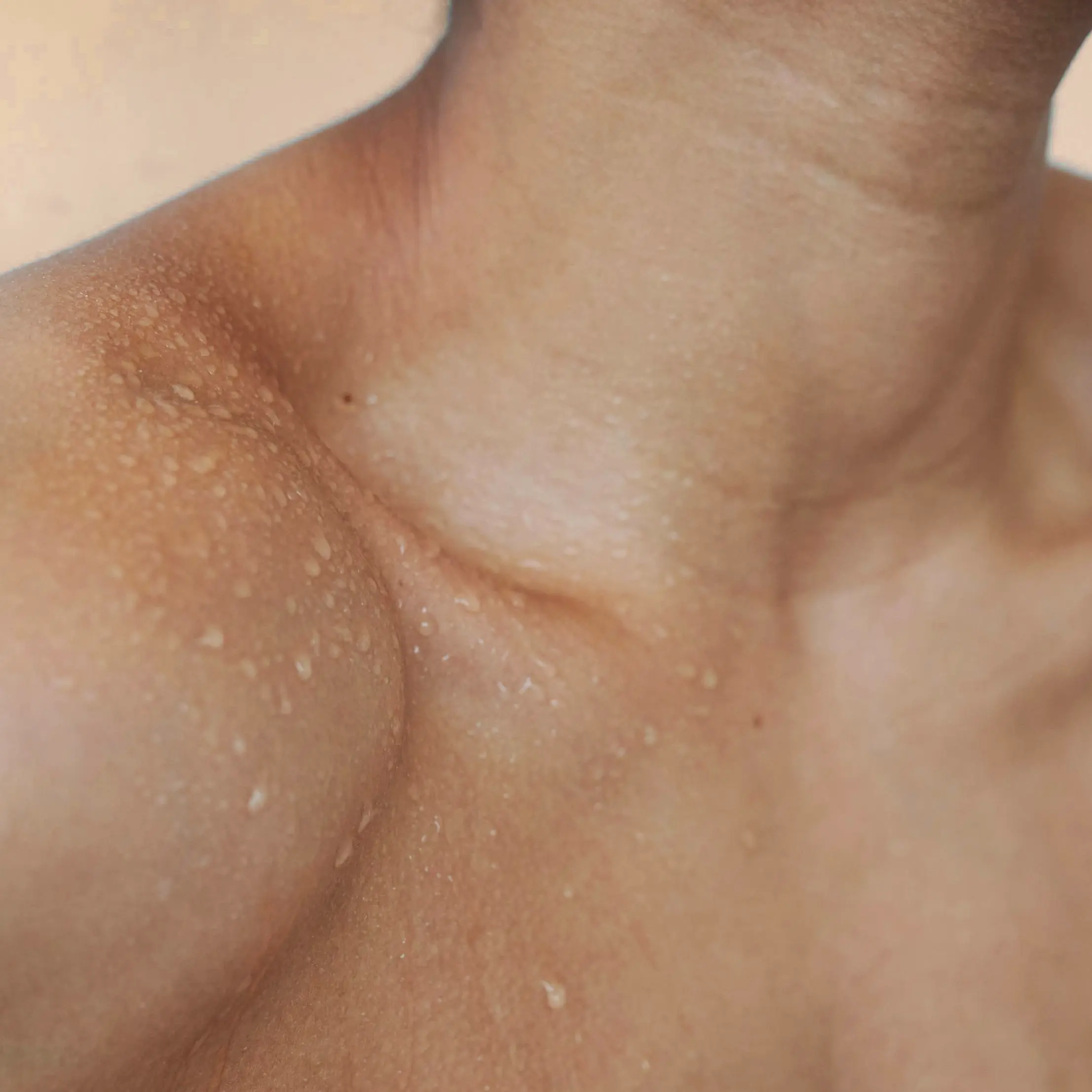 moist skin