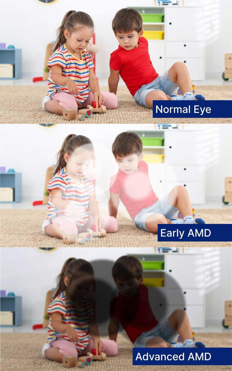 stages of AMD