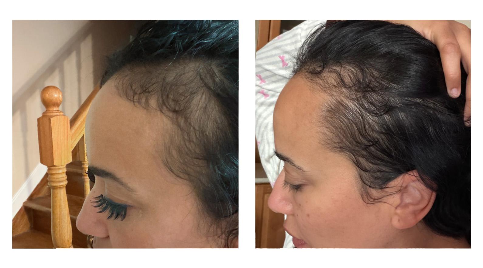 Rachel after 3 months - side