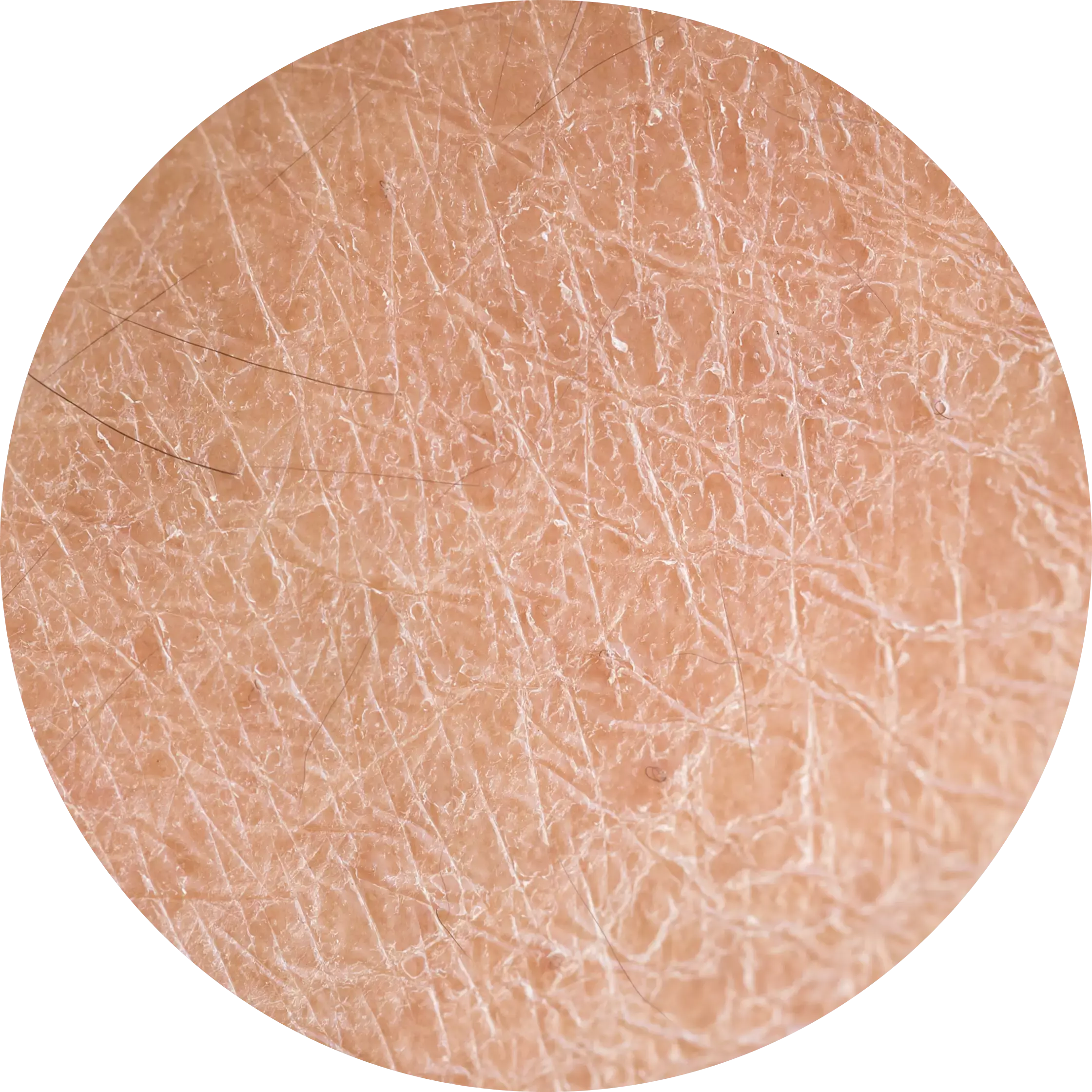 Dry Skin