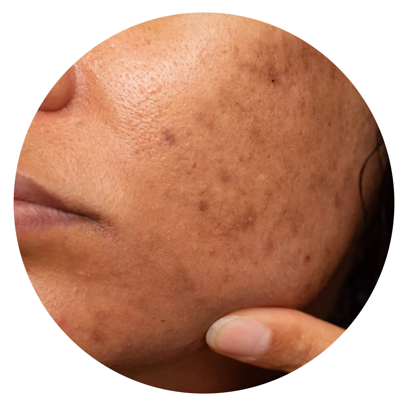 Pigmentations and Dark Spots