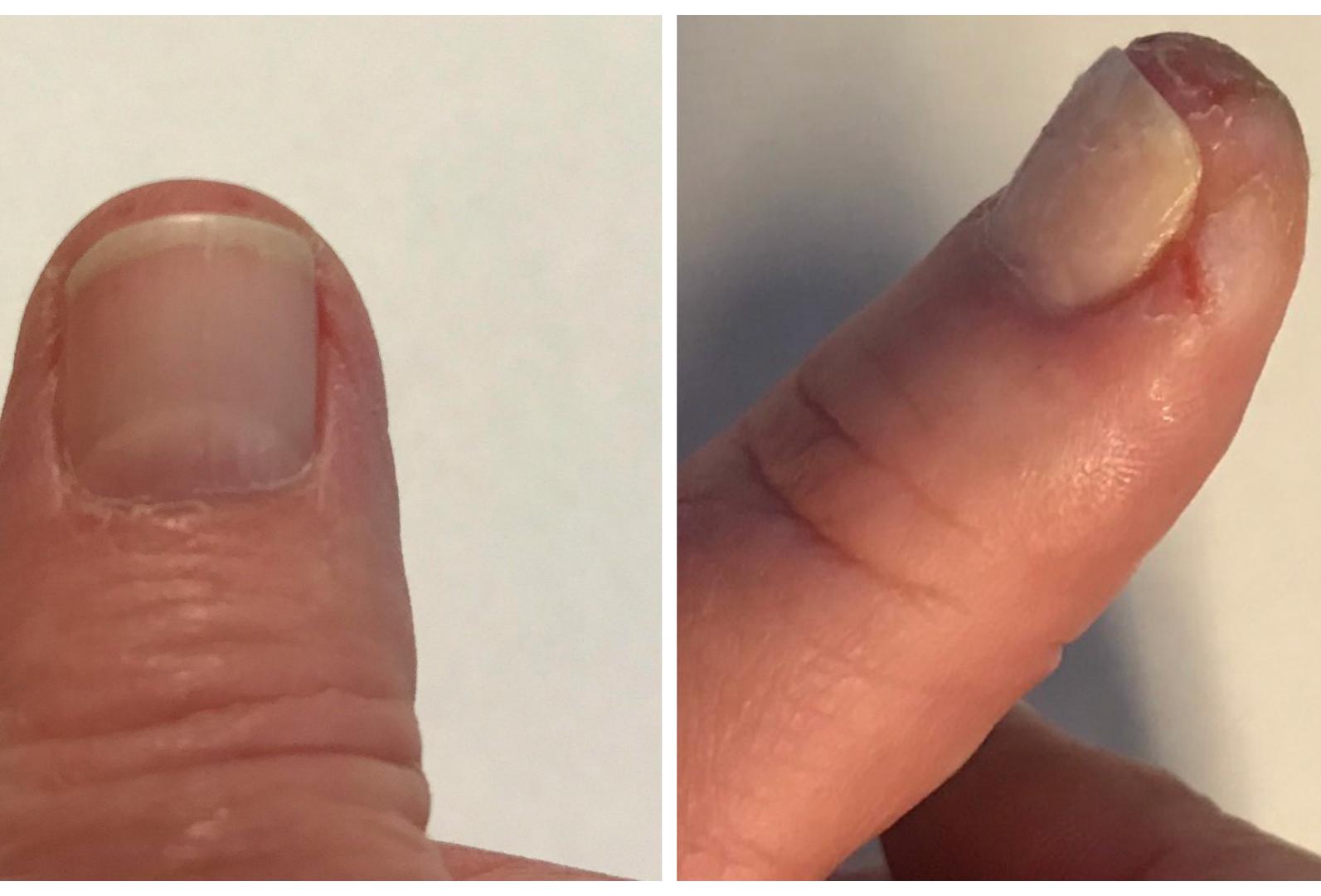 before and after splits on fingers