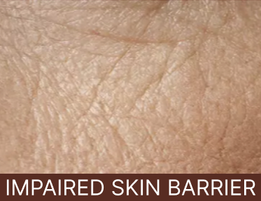 Impaired Skin Barrier - Mobile