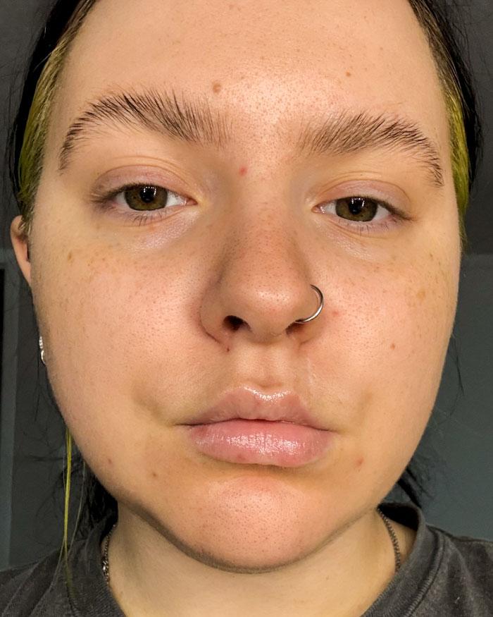 Before photo of Aria showing mild blemishes and uneven skin tone.