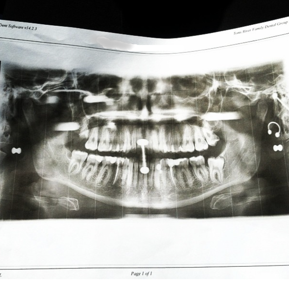 10 Fascinating Pictures of Body Jewelry in XRays