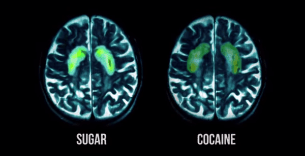 Brain Scan Sugar Cocaine
