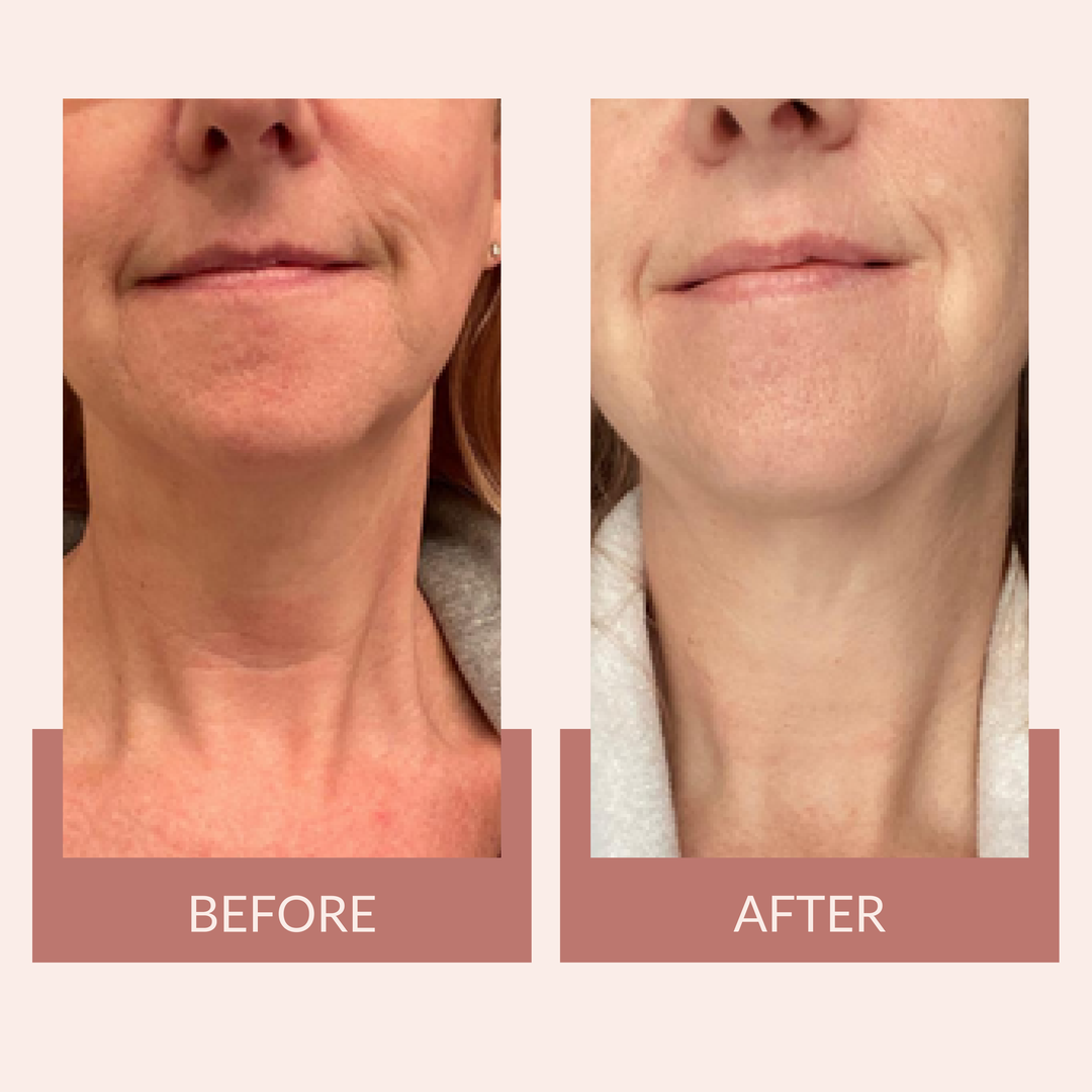 Blumbody Silicone Care Neck Pad Before & After