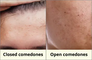 different type of Comedones