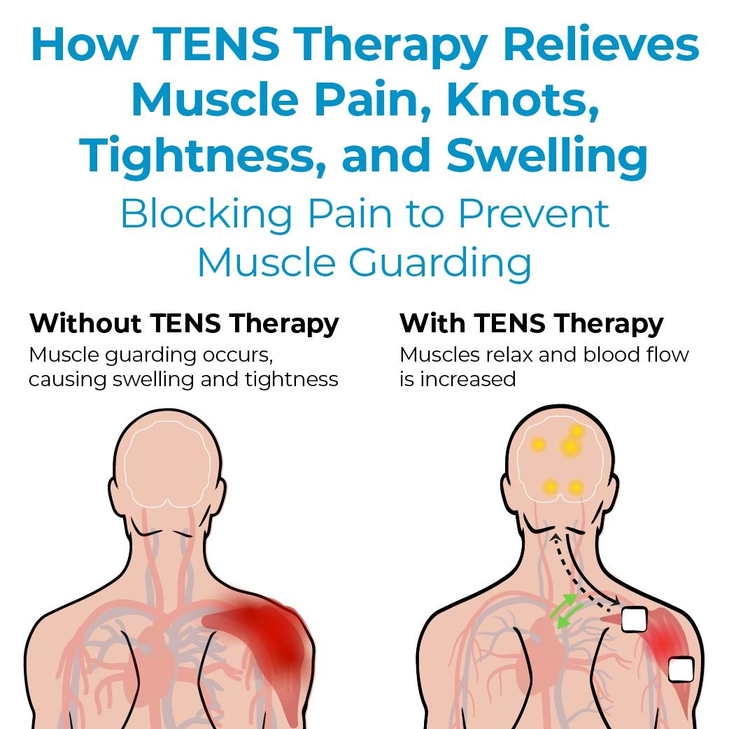 Using TENS Therapy for Muscle Pain Relief – TENS 7000