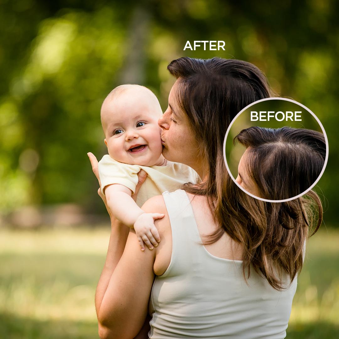 young mum with hair loss