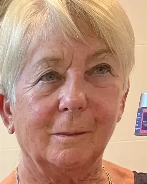 After image of customer 4